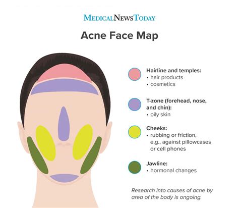 Acne Face Map Mouth