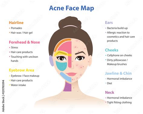 Acne Face Map Under Chin
