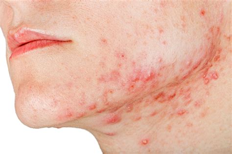 Jawline acne Causes, treatment and prevention