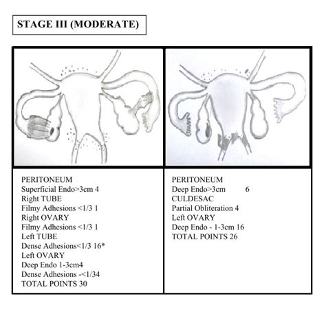 acog endometriosis patient information