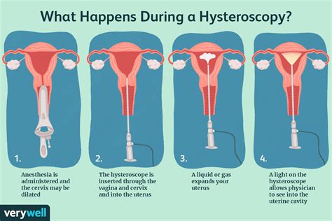 acog hysteroscopy patient information