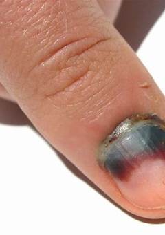 Acrylic Bruised Nail In 2023