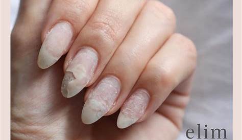 Fingernail Fungus from Acrylic Nails Causes, Treatment, More My