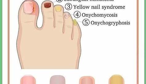 Acrylic Nails Disease Everything You Need To Know About — The Avenue