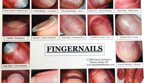 Acrylic Nails Problems Symptoms Figure 1 From Severe Onychodystrophy Due To Allergic