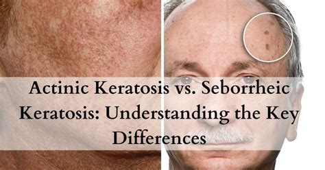 actinic keratosis versus seborrheic keratosis