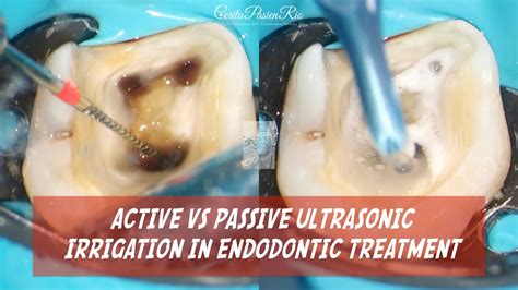 Activation Of Endodontic Irrigants