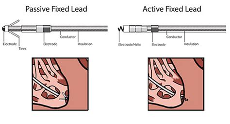 Active Fixation Lead Vs Passive