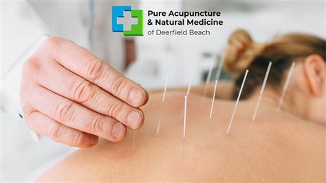 Acupuncture Boca