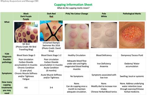Acupuncture Cupping Marks
