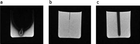 Acupuncture Needle Mri