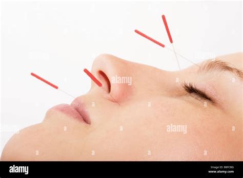 Acupuncture Needles In Face