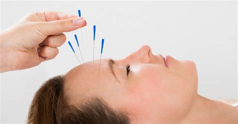 acupuncture treatment migraine headaches