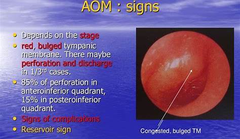 Acute Otitis Media Images Rosh Review Nurse Practitioner Education