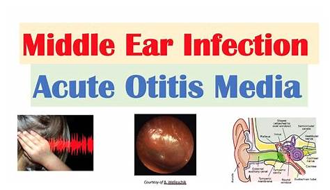 Treatment For Acute Otitis Media Otitis Otitis Media Ear Infection Symptoms