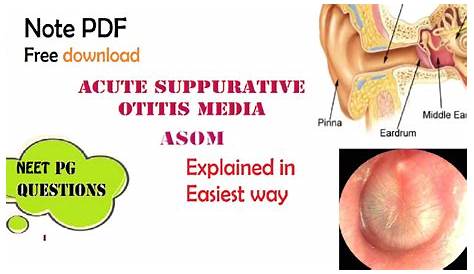 Acute Suppurative Otitis Media Treatment Otoscopy Views Emergency Medicine Otolaryngology Audiology