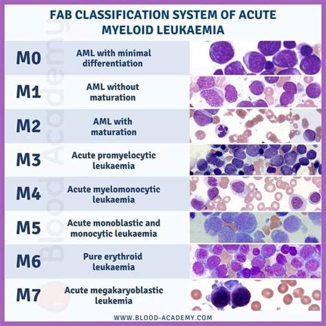acute aml