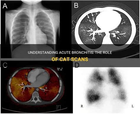 Acute Bronchitis Kat