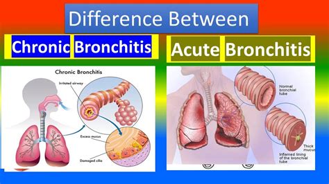 Acute Bronchitis Narcotic