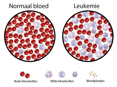 acute leukemie symptomen volwassenen