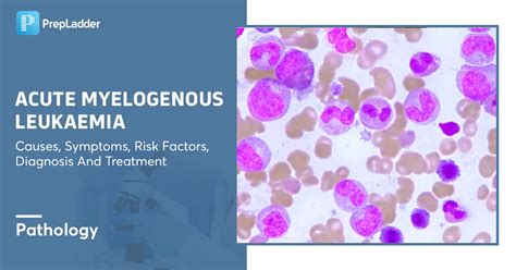 acute myelogenous