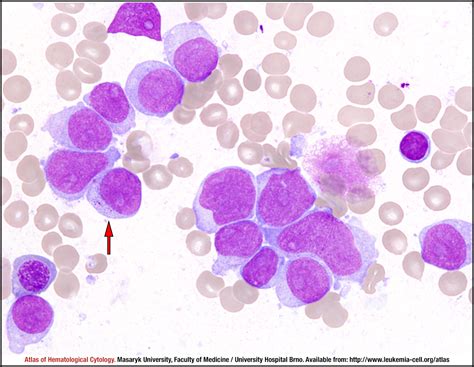 Acute myeloid leukemia causes, symptoms, prognosis and treatment