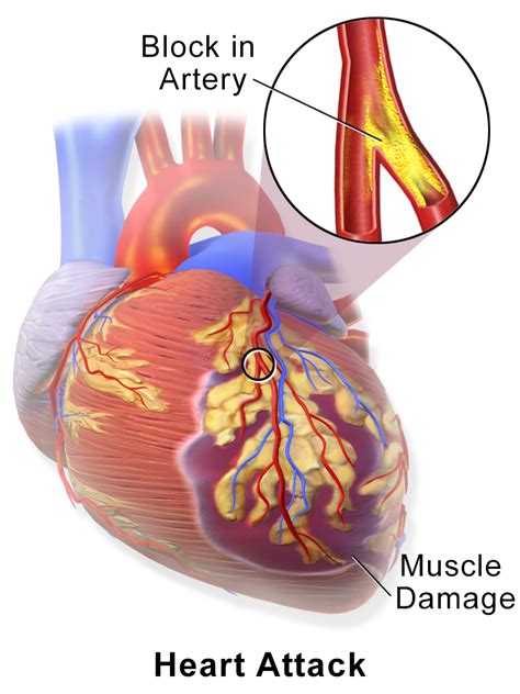 acute myocardial infarction vs heart attack