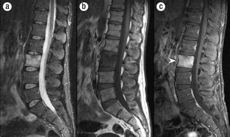 acute osseous abnormality of the lumbar spine
