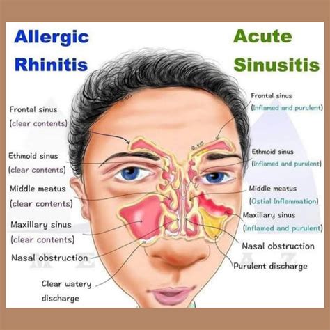 acute sinusitis vs sinus infection