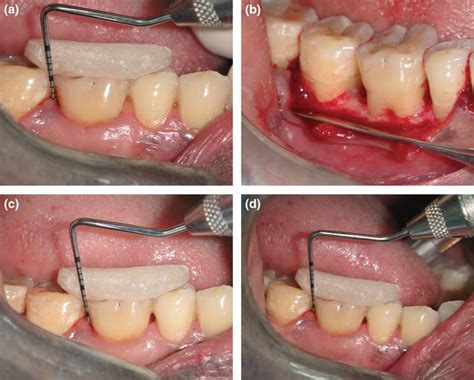 Ada Code For Single Tooth Debridement