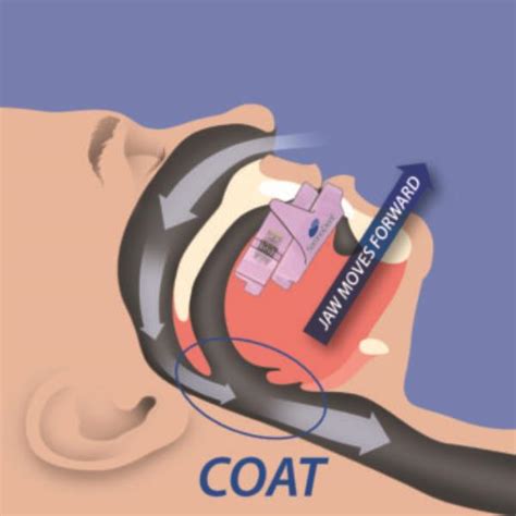 ada code for sleep apnea device dental