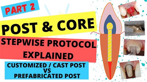 ada code prefabricated post and core