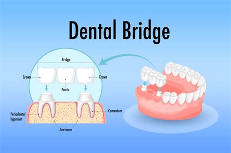 ada dental code for bridge