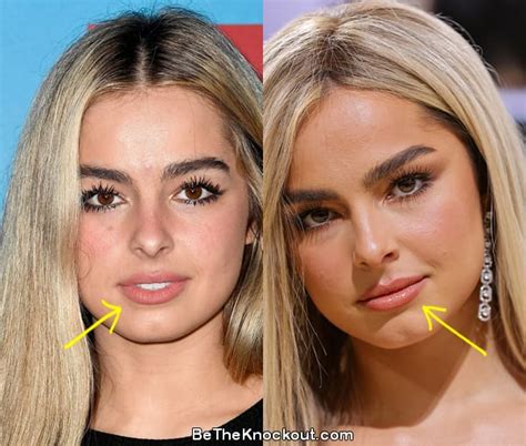 addison rae plastic surgery