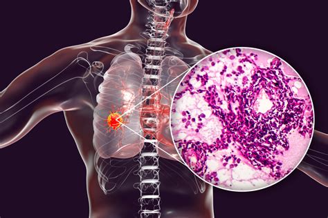 adenocarcinoma cancer