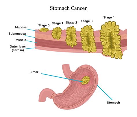 adenocarcinoma cancer stomach stages