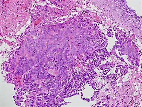 adenocarcinoma distal esophagus icd 10