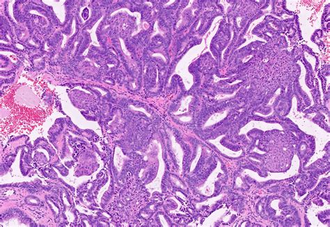 adenocarcinoma endometrium pathology outlines