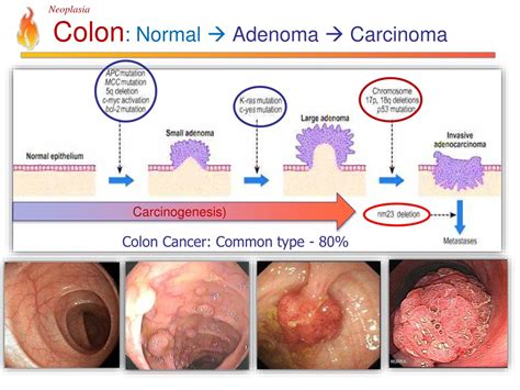 adenocarcinoma of colon icd 10