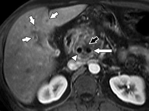 adenocarcinoma pancreas radiopaedia