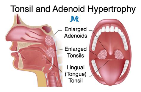 Adenoids and tonsils removal side effects