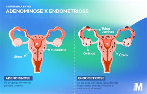 adenomiose uterina e endometriose
