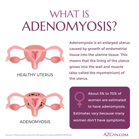 adenomyosis of the uterus treatment