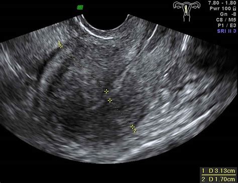 adenomyosis of the uterus ultrasound findings