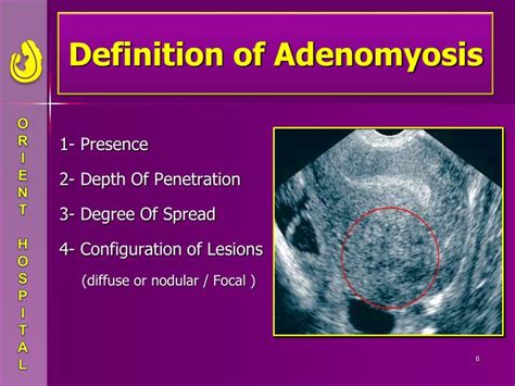 adenomyosis of uterus ppt