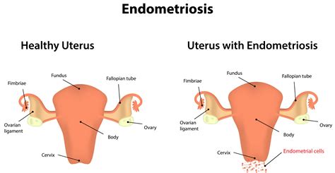 adenomyosis vs endometrial cyst