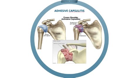 Adhesive Capsulitis Evaluation