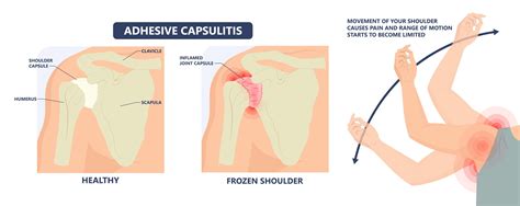 Adhesive Capsulitis Grading