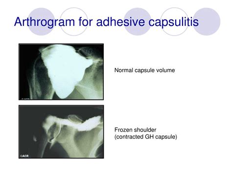 Adhesive Capsulitis Physical Exam