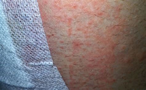 Adhesive Plaster Allergy